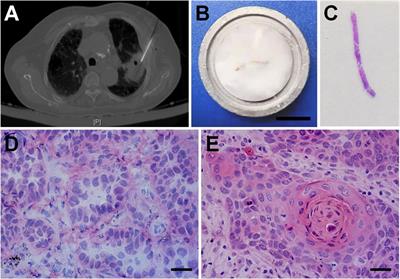 Comparison of Multi-Gene Testing Data Between Fresh and Formalin-Fixed Specimens From Core Needle Biopsy in Patients With NSCLC